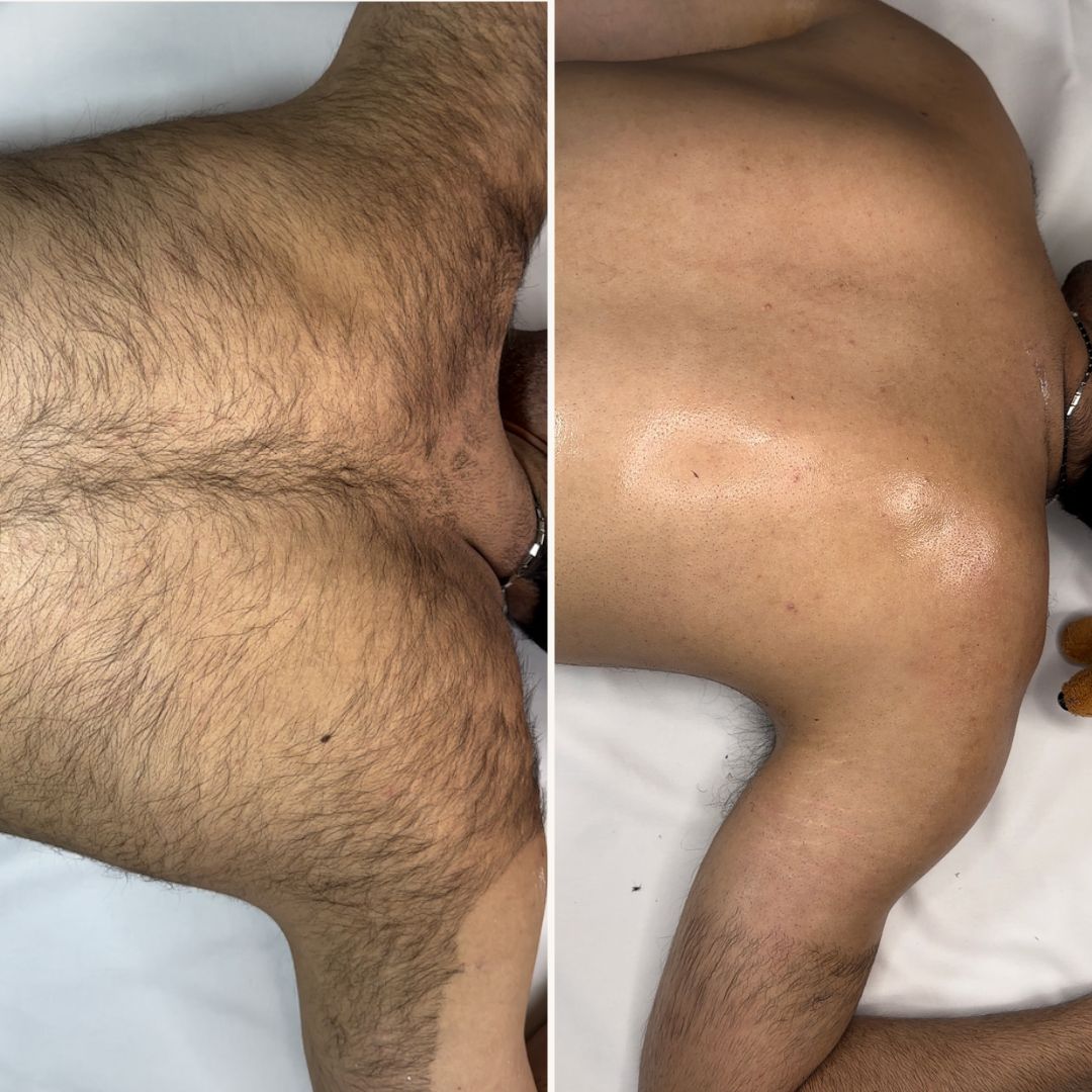 Body Hair Removal Powder